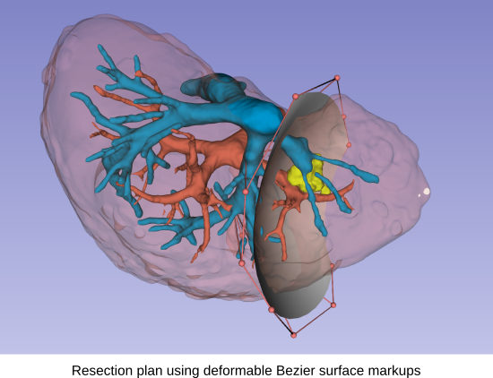 Resection planning